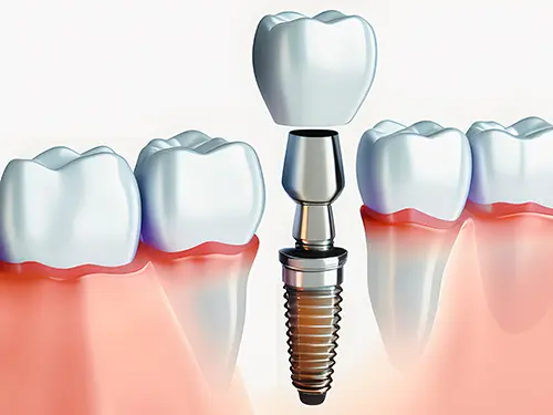 Zahnimplantat - Dr. Luckmann im Bezirk Spittal